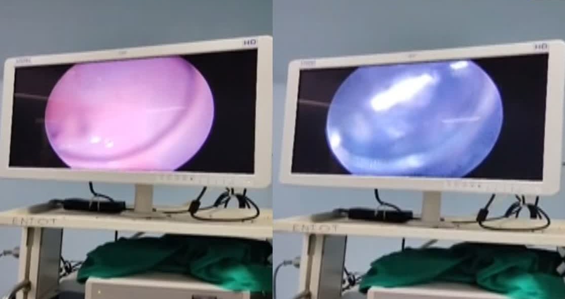 Doctors removed a toothbrush stuck in the throat